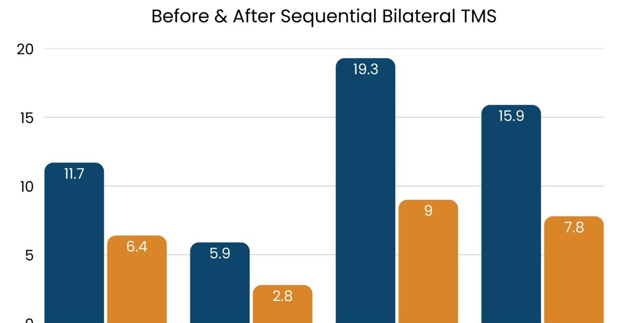 Sequential Bilateral TMS Protocol Offers Durable Relief for PTSD Patients